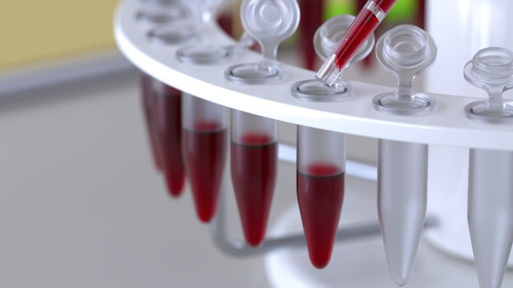 ΗΠΑ: Έλληνας o επικεφαλής ομάδας ερευνητών που ανέπτυξε αιματολογικό τεστ για τη διάγνωση 8 μορφών καρκίνου