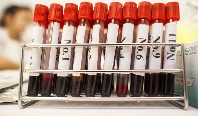Περισσότερες πληροφορίες για "Ερευνητές επιδιώκουν τη διάγνωση της νόσου του Πάρκινσον μέσω του αίματος"