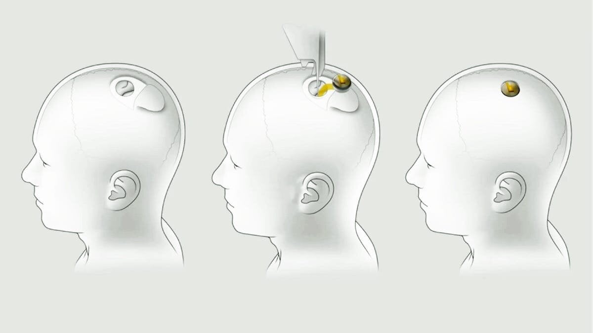 Περισσότερες πληροφορίες για "Η Neuralink πραγματοποιεί την πρώτη εμφύτευση μικροτσιπ σε ανθρώπινο εγκέφαλο"